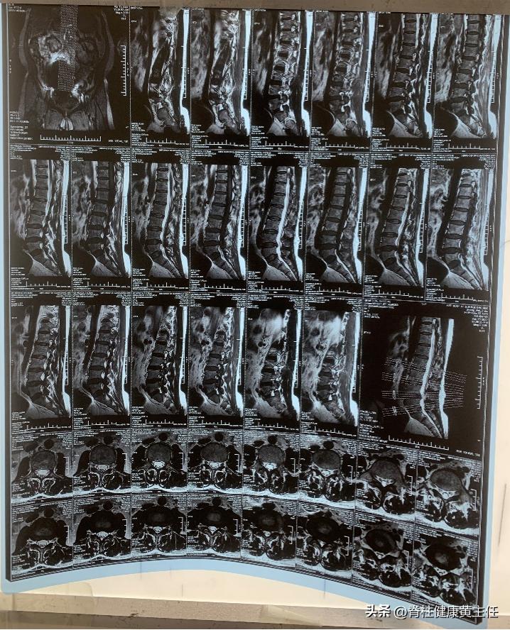 腰突大腿前侧麻是怎么回事,腰突导致腿麻是哪个位置