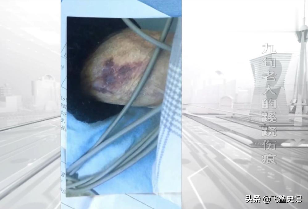 母亲被火灾烧伤,母亲被火烧死后续