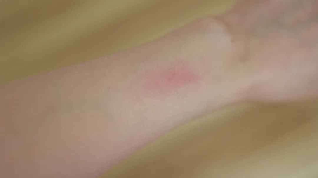 过敏性紫癜中医与西医哪个方法好,治疗过敏性紫癜中医和西医哪个好