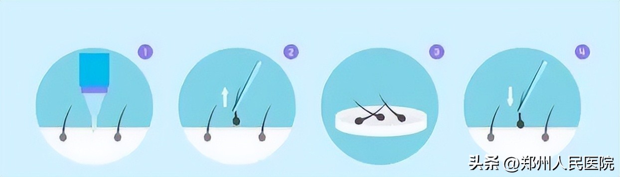 种植眉毛有哪些方法图,怎么种植眉毛效果最好