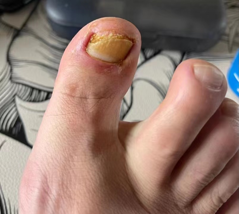 权威专家灰指甲怎么治才能除根,灰指甲去除演示图片