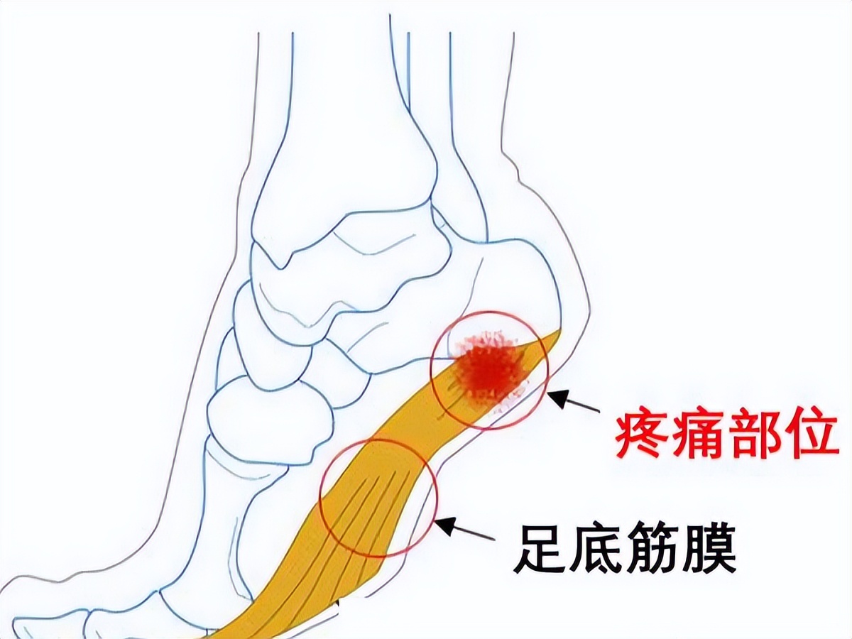 脚底中间疼痛警惕四种病,脚底疼痛警惕四种病怎么调理
