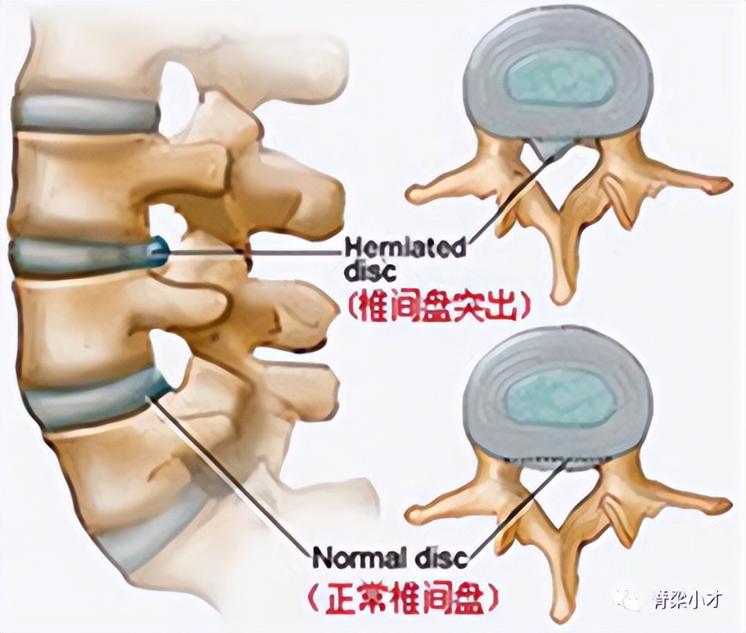 腰椎间盘突出症的诊断与鉴别,腰椎间盘突出和膨出的区别在哪里