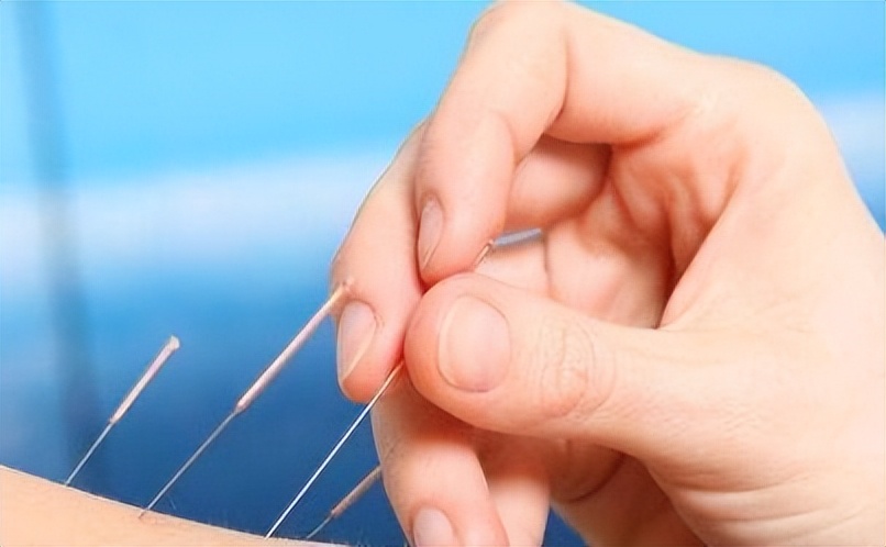 神经根型颈椎病能刺血拔罐治疗吗,拔罐针灸治疗颈椎病北京哪个医院