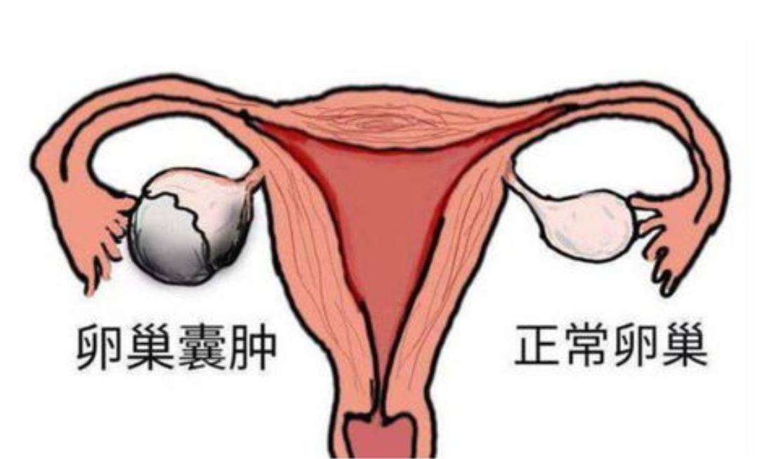 卵巢囊肿怎么治才能不影响生育,卵巢巧克力囊肿癌变的10个征兆