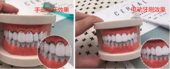 电动牙刷到底怎么样,电动牙刷买的不好的会伤牙吗