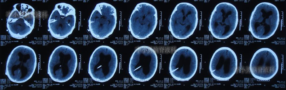 脑积水手术后4天还呕吐怎么回事,脑积水分流术后一直腹部疼痛