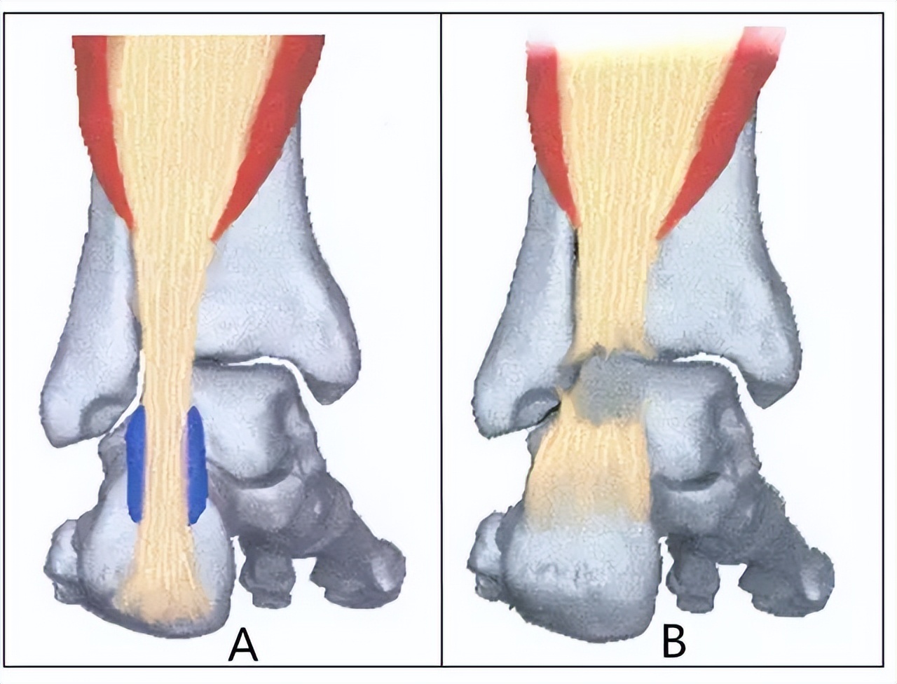 足球运动员跟腱撕裂手术,运动员跟腱断裂接受治疗全过程