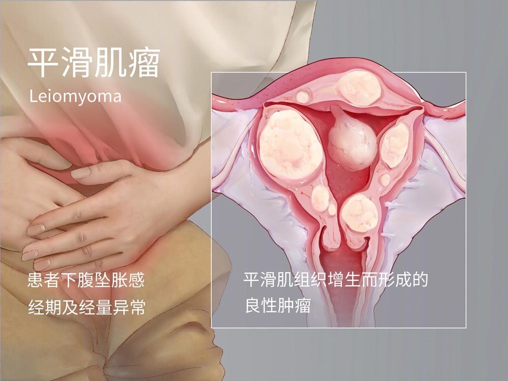 你吃了啥，瘤子能“养”这么大？42岁美女驻颜有误，这里险些保不住