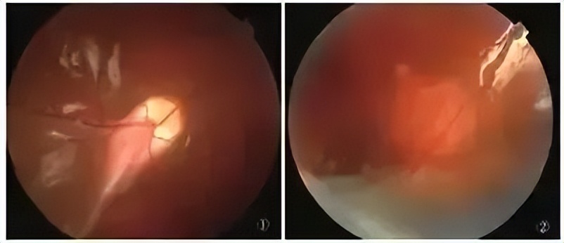 打篮球适合戴ok镜,戴眼镜不能踢足球吗