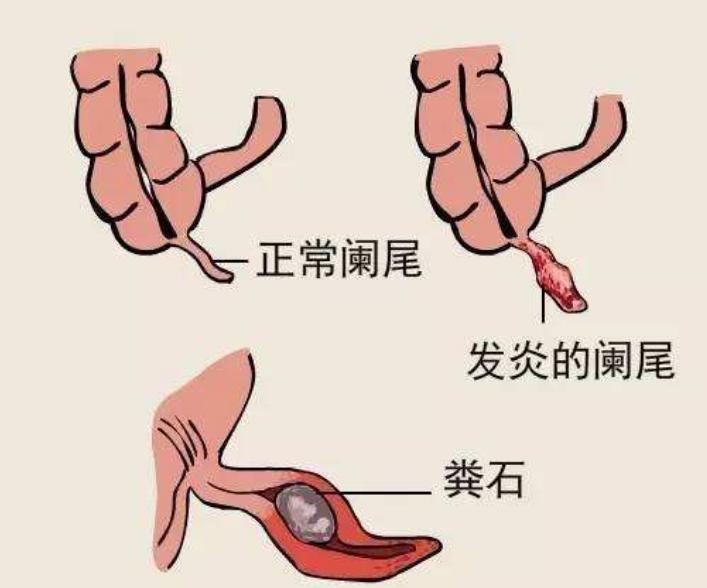 剧烈运动会得盲肠炎吗,饭后一小时剧烈运动会得盲肠炎吗