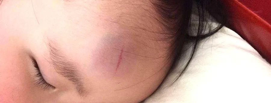 宝宝磕着碰着了怎么处理？