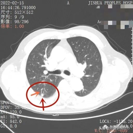 肺腺癌高危亚型什么意思,肺腺癌高危亚型
