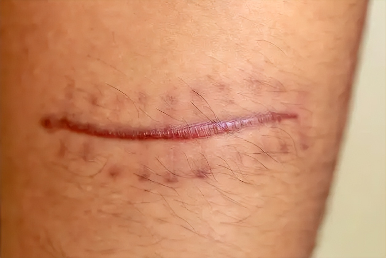 祛疤后疤痕增生怎么办,术后疤痕增生可以不使用祛疤膏吗