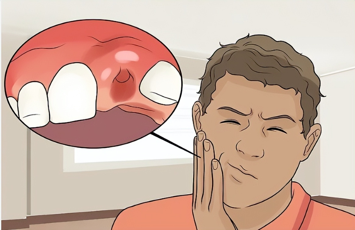 拔牙后伤口好了牙龈肿痛,拔牙后牙龈如何快速消肿