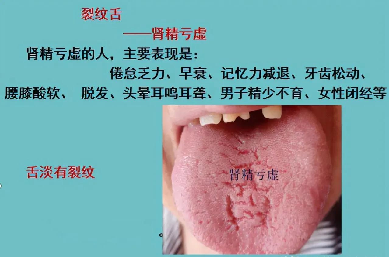 阴虚裂纹舌怎么调理,裂纹舌调理的经历