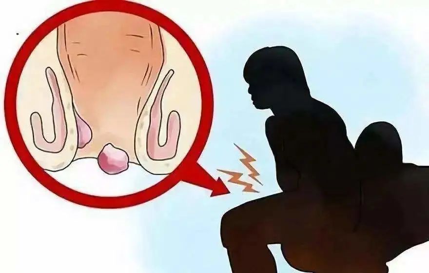 中医治疗肛瘘动画演示,肛瘘在中医上是湿热吗