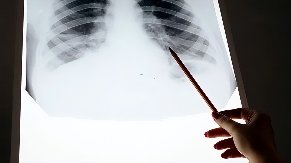 类风湿肺病变怎么治疗,类风湿加肺纤维化会引起上火吗