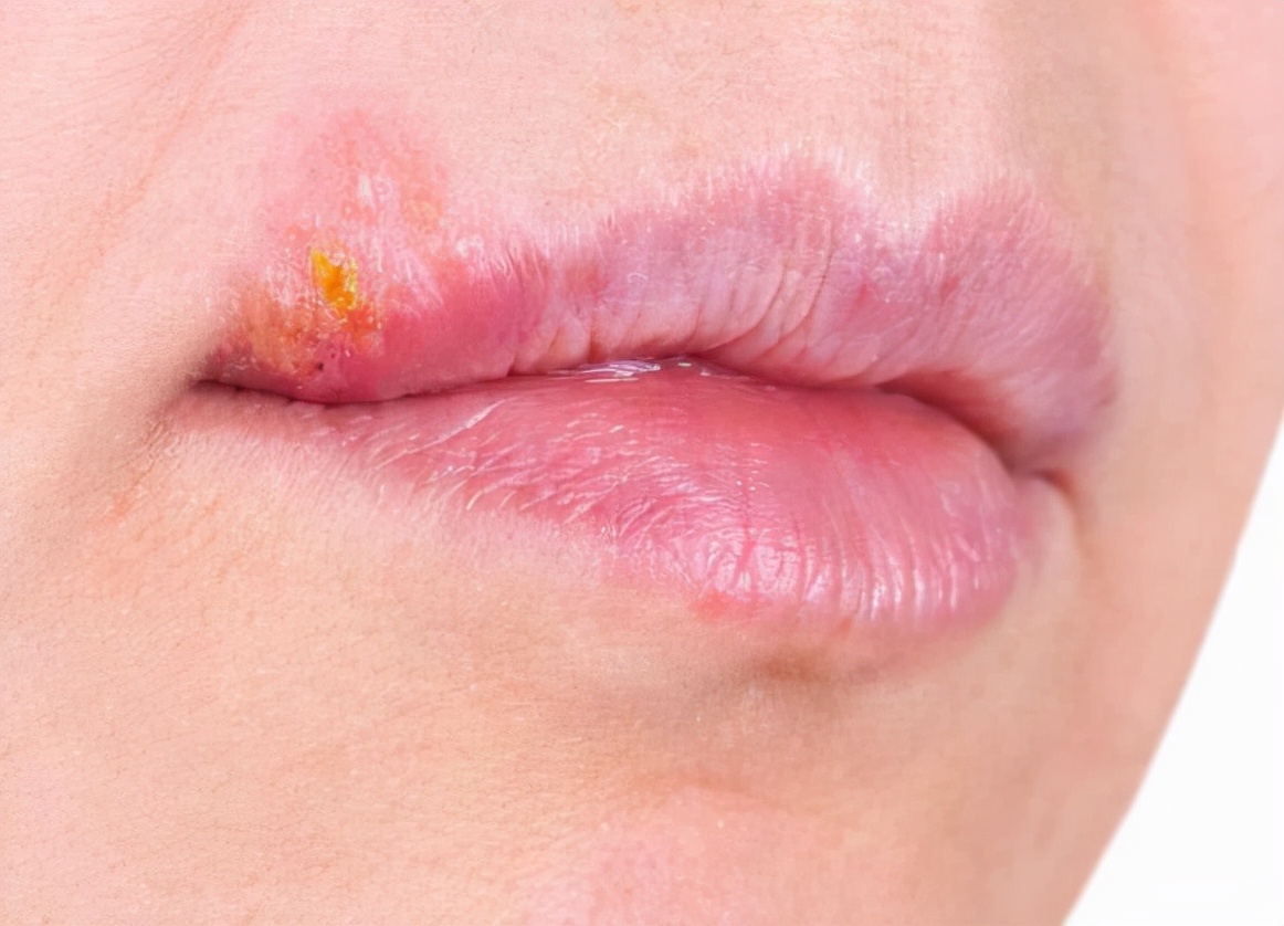 嘴巴旁边很多小水泡会留疤吗,嘴巴周围长一堆小水泡是上火吗