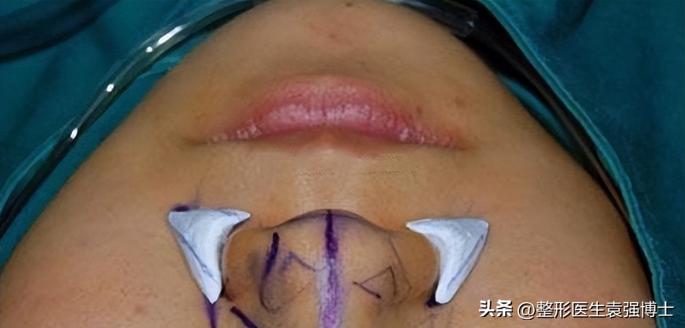 法令纹难解决,法令纹好严重怎么办