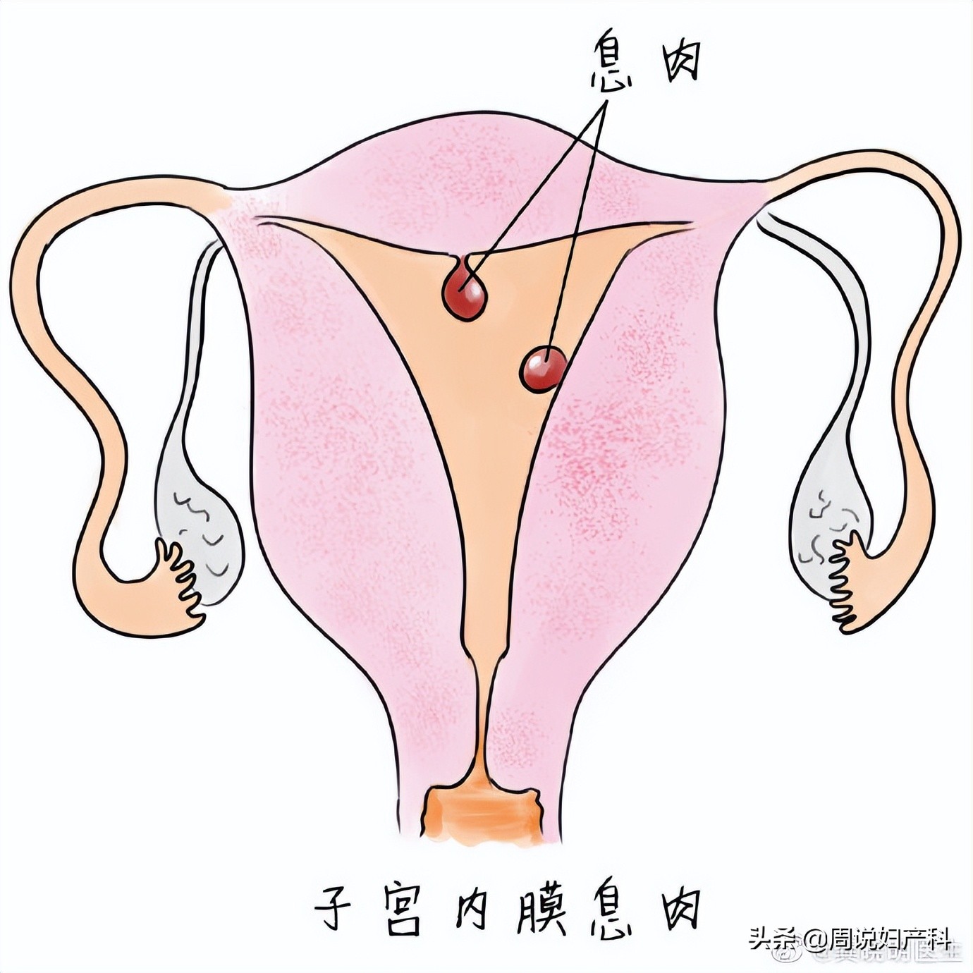 子宫里为什么会长息肉,需要手术吗?