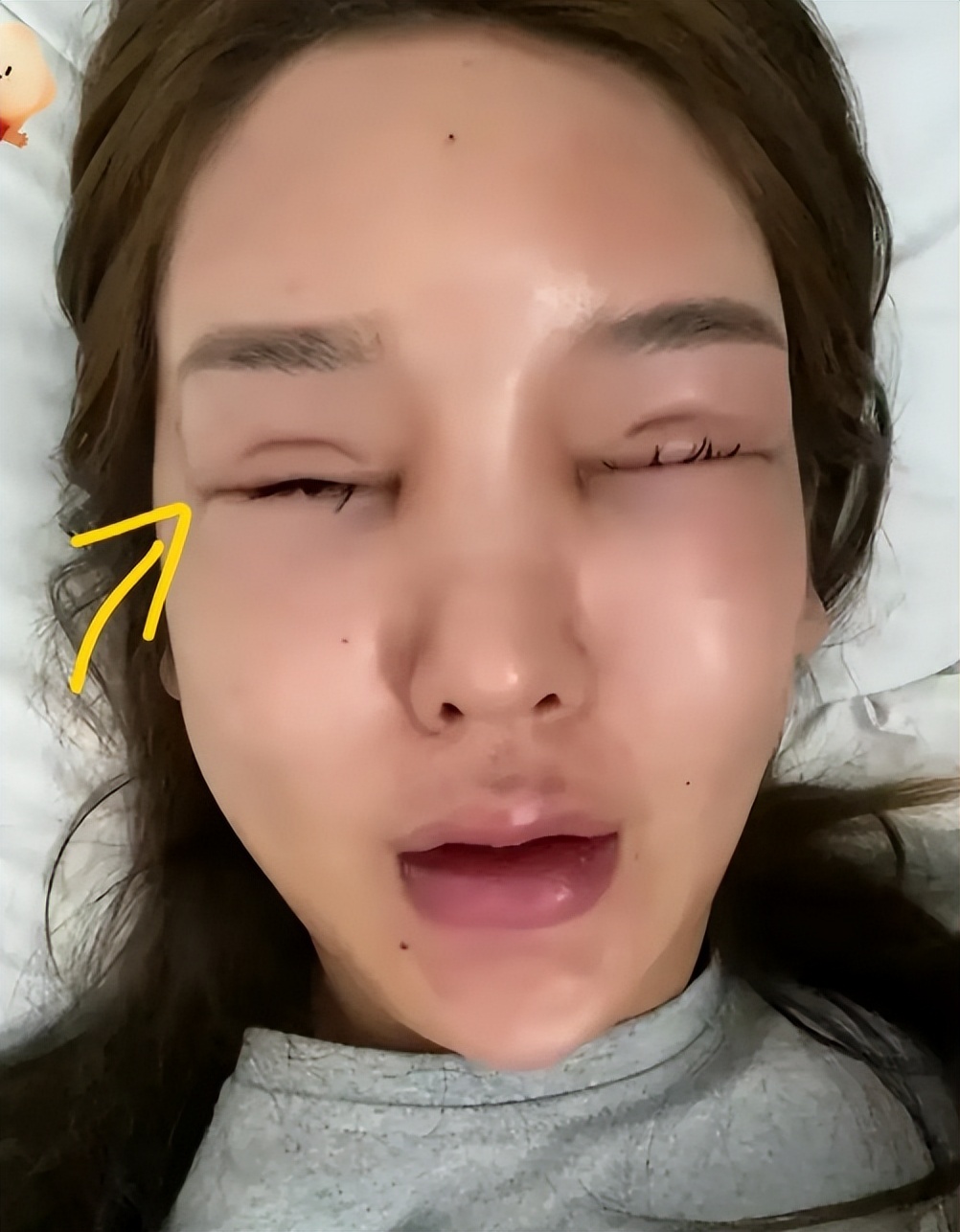 “桃花宝宝”迷恋整容，八年花费上百万，嘴歪眼斜额头出现大坑