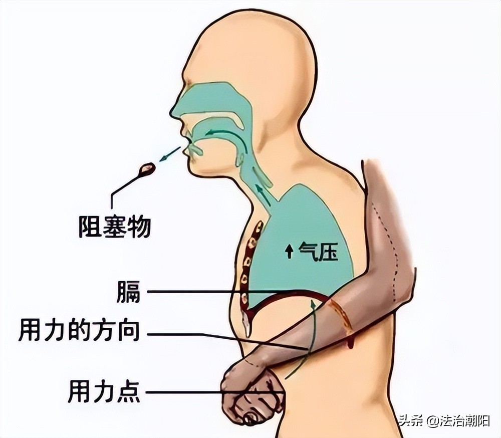 异物卡喉海姆立克急救法,异物卡喉海姆立克急救法正确步骤