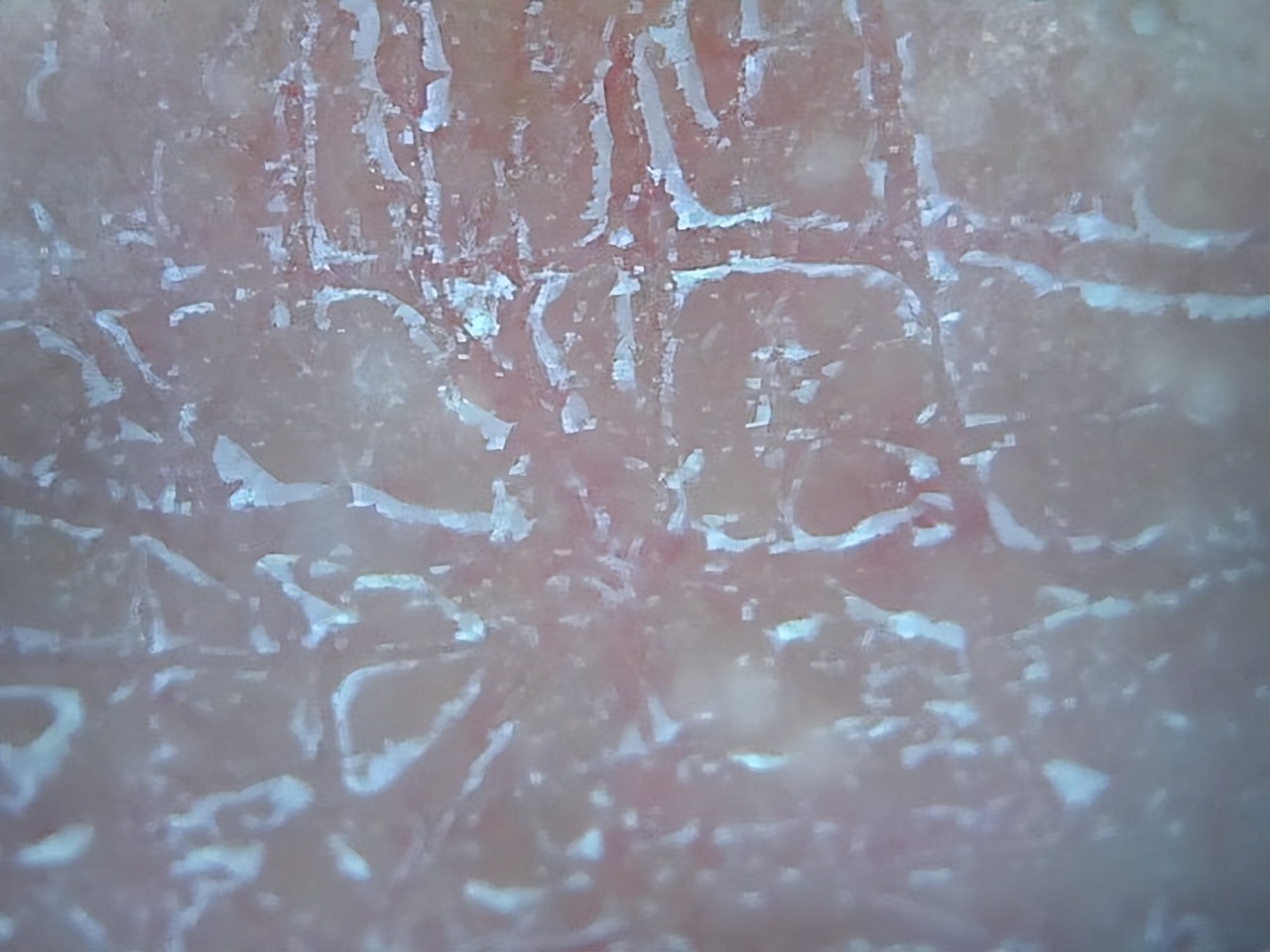 一到秋冬季双手就脱皮怎么治疗,一到春天手心就开始干燥脱皮