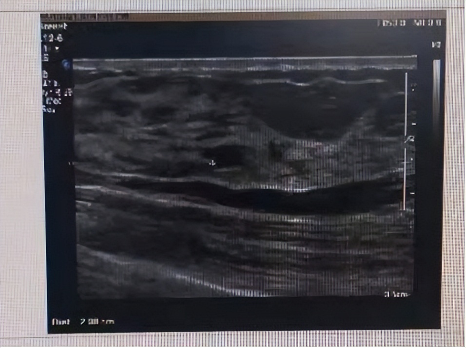 乳腺非典型增生癌变是早晚的事吗,检查出乳腺增生吃什么药