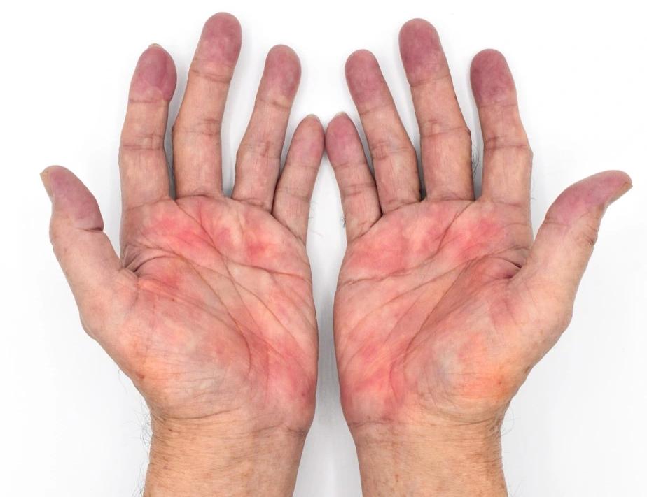 肝脏出问题皮肤痒是什么样子,肝脏疾病引起的皮肤瘙痒如何医治