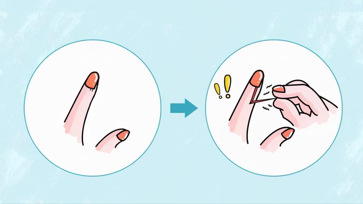 指甲往肉里长怎么办,指甲老往肉里钻