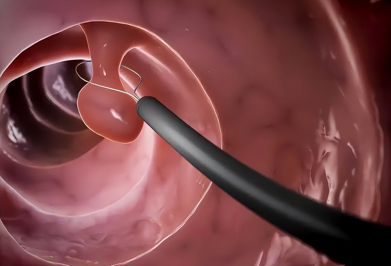 肠道长息肉有哪些明显的症状,肠道长息肉了会有什么症状