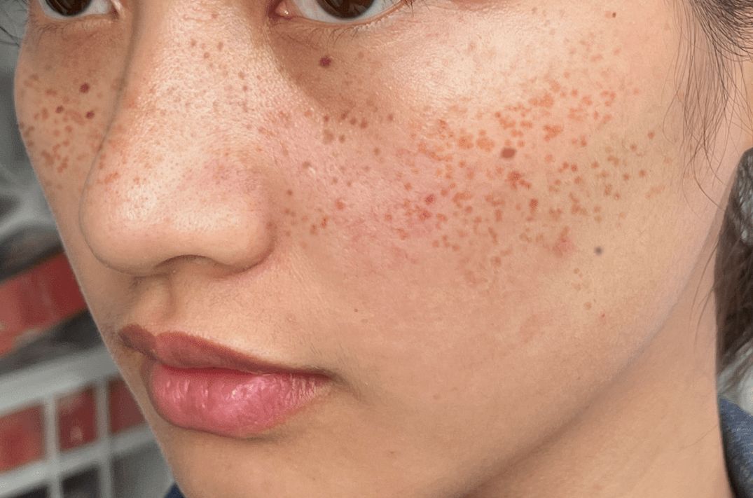 娣″寲鏂戠偣杩樿兘瀚╃櫧鑲岃偆,閲嶇幇瀚╃櫧鑲岃偆璧惰蛋鏂戠偣