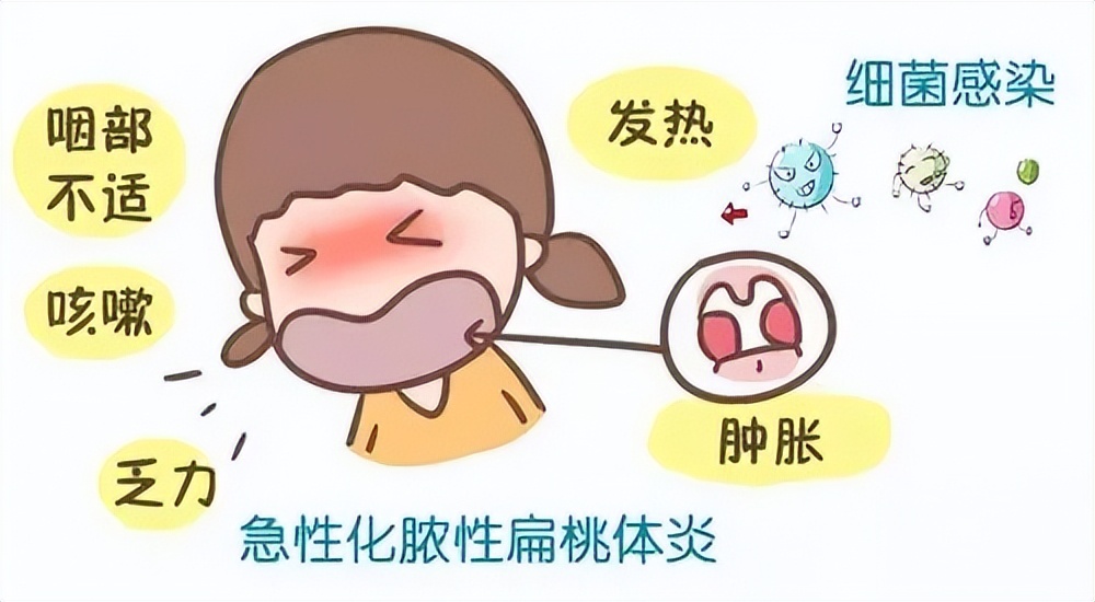 扁桃体发炎和扁桃体脓肿哪个严重,如何有效缓解扁桃体发炎