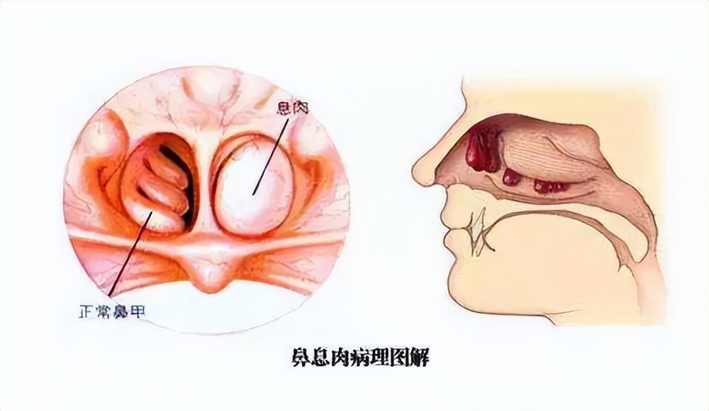 科普知识：鼻子里长了鼻息肉该怎么办？