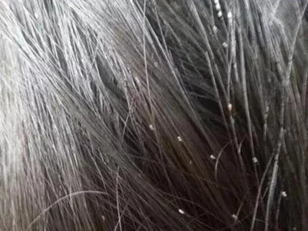 小时候头上长虱子的事,小时候头上的虱子是什么样子的