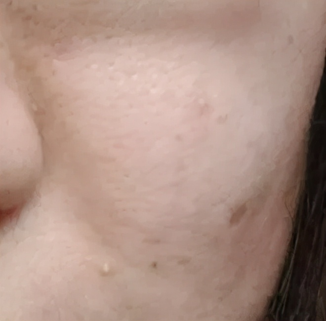 第一次打水光针爆痘,第一次打水光针反黑了