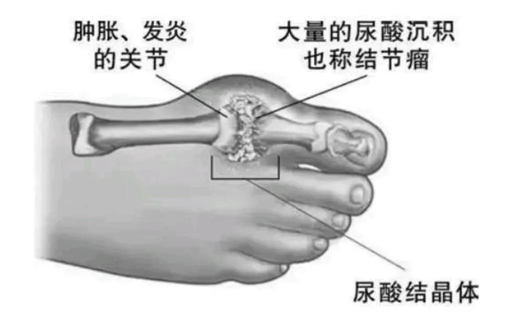 氢气水能治痛风吗,求治疗痛风特效药