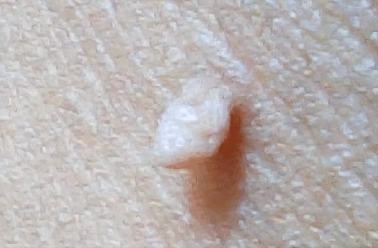 脖子和腋下的“小肉粒”是什么？能直接用手揪掉吗？医生揭露真相