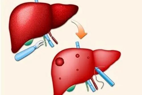 有关肝囊肿的十大常见问题,多发性肝囊肿的治疗偏方