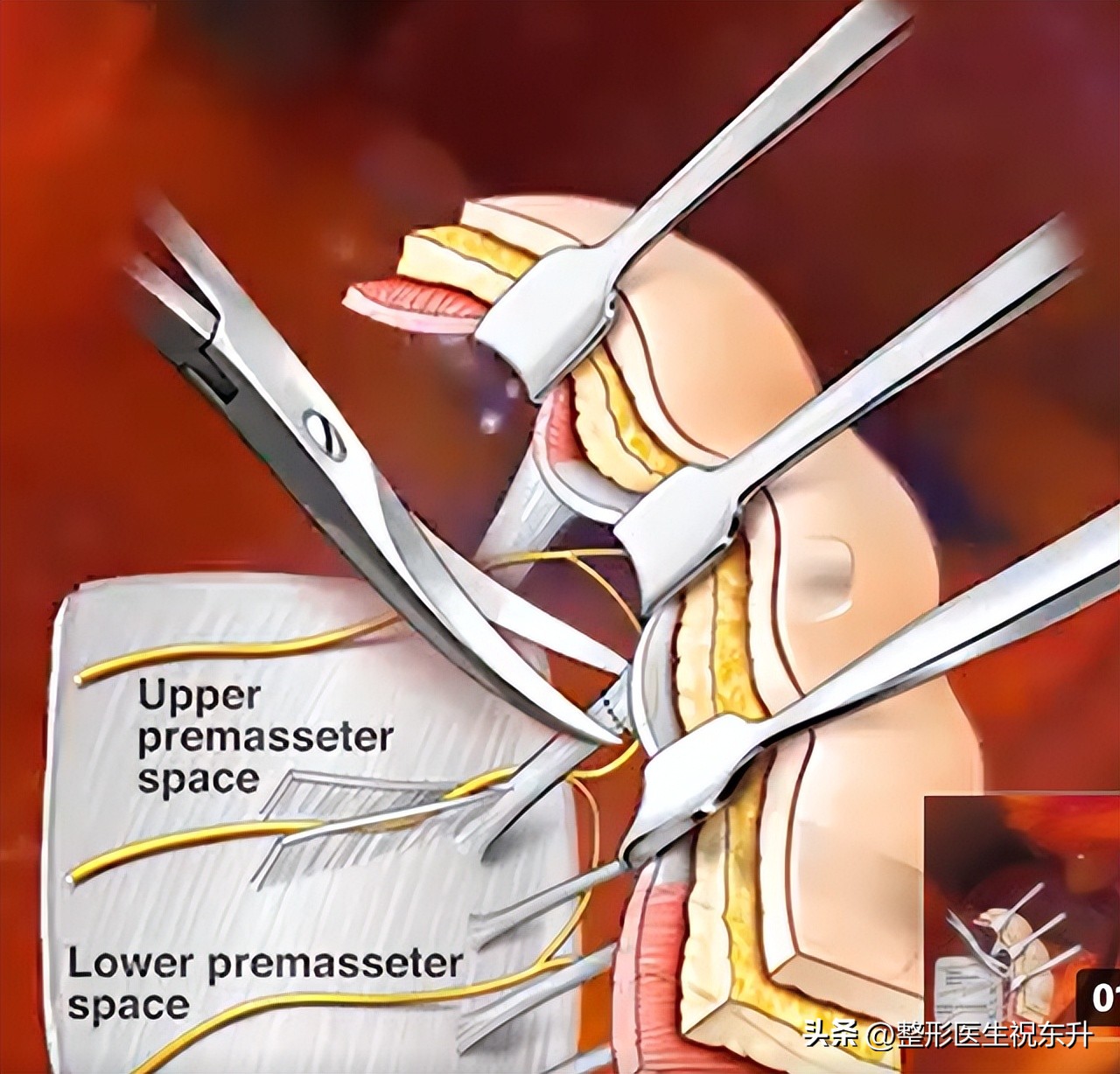 微整形面部提升拉皮,微拉美面部提升手术真的这么好吗