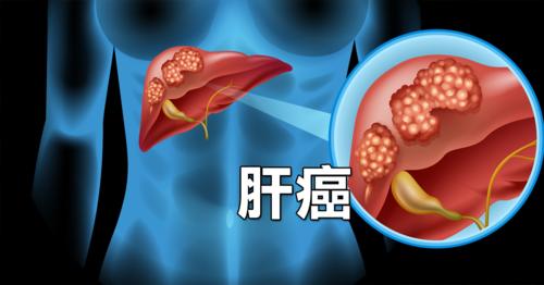 肝癌小细胞癌的治疗方法,肝癌的诊断和治疗方法简答题