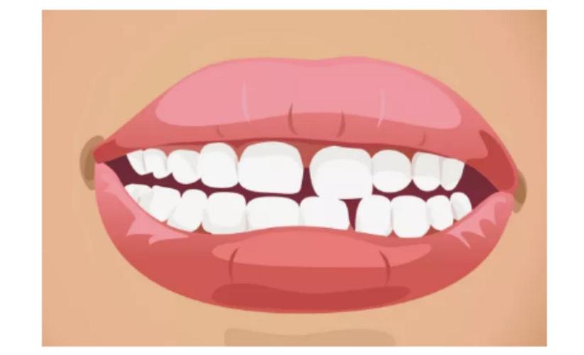 牙缝大怎么补,牙缝大对牙齿危害最小的修复方法