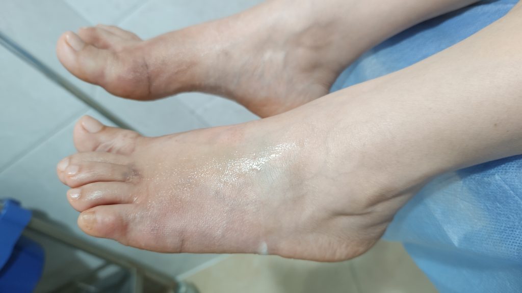 脚肥脚宽如何改善,脚肥怎么办教你一招