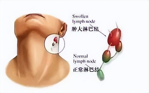 慢性白血病的征兆有哪些,慢性淋巴白血病之前会有什么征兆