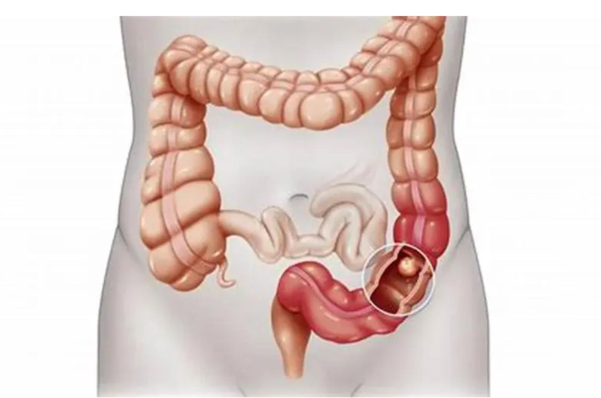 结肠长息肉是什么原因造成的,结肠息肉切除肚子还疼是什么原因