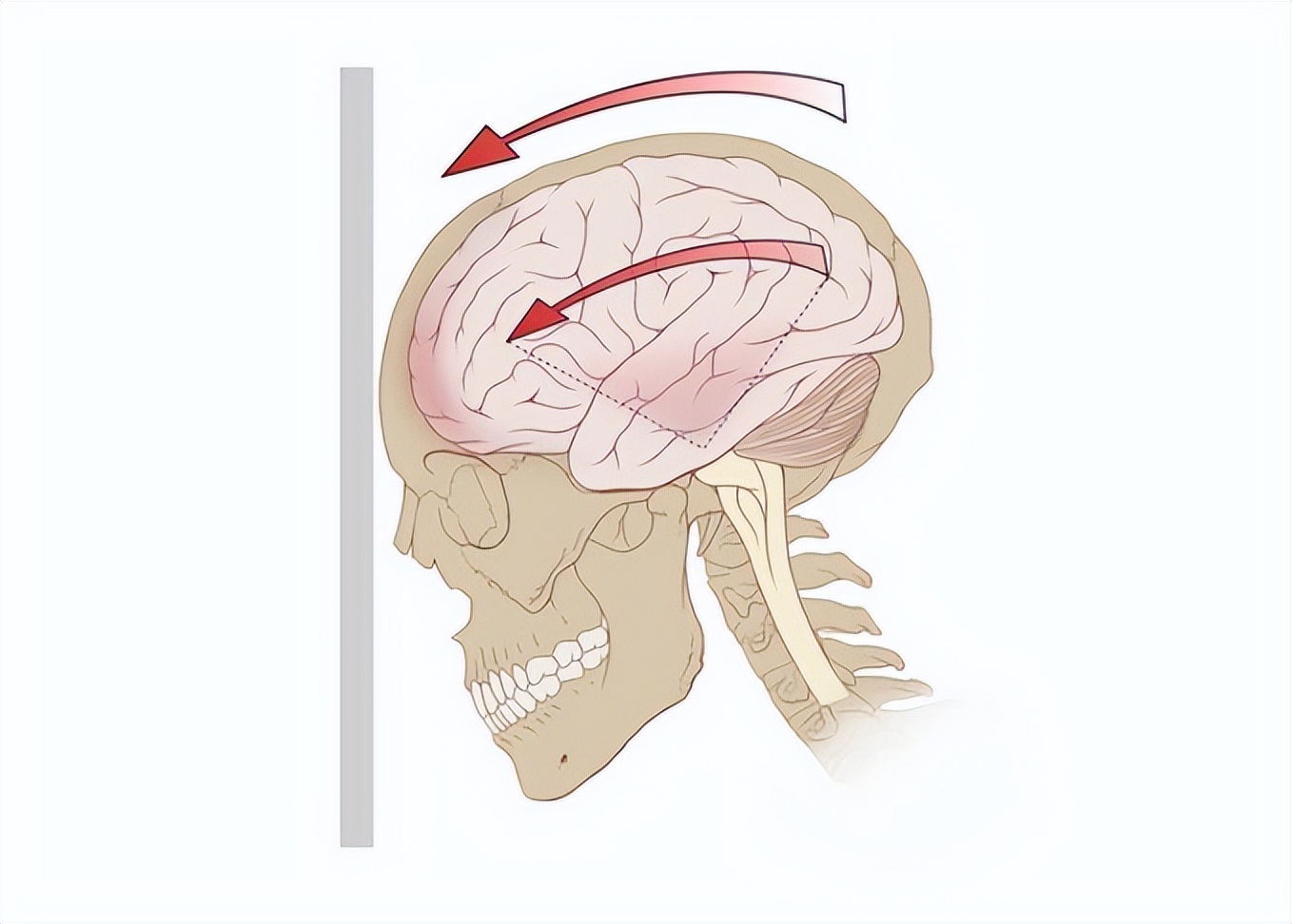摔车脑震荡,车祸脑震荡恢复的最佳方法