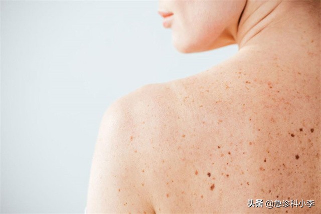 身上出现不痒的小红点是怎么回事,身上突然起了很多小红点不痛不痒