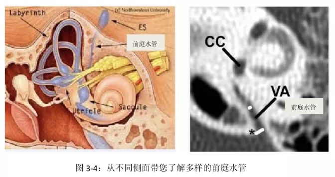 大前庭导水管正常值,大前庭导水管结构