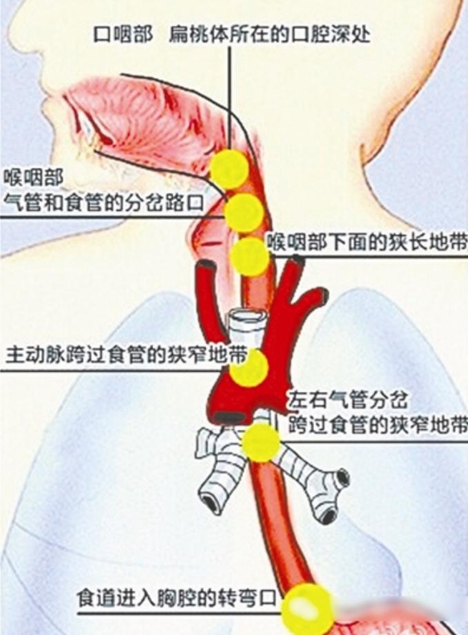2010年,厦门小伙连续3月反复高烧,医生打开心脏夹出3厘米的鱼刺